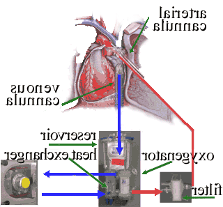 artificial heart